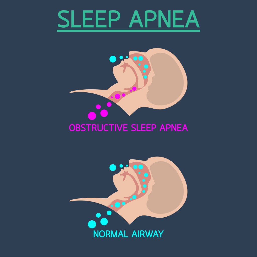 Sleep Apnea: Signs, Symptoms, and What to Do Next